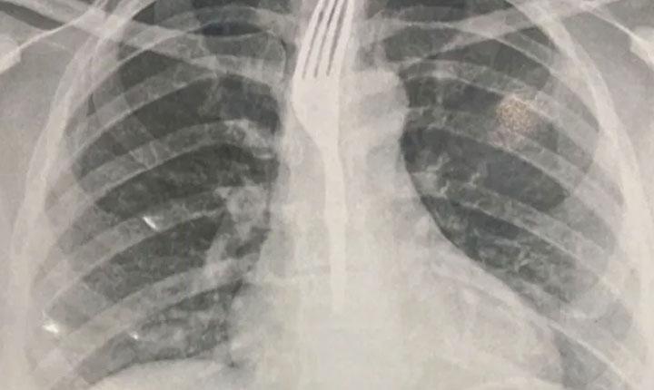 Mulher engole garfo durante refeição em Guanambi; Saiba mais