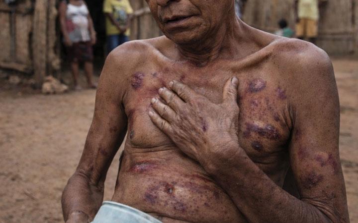 Estudo revela cenário preocupante de doença de Chagas em comunidades indígenas de Santa Cruz Cabrália; Entenda