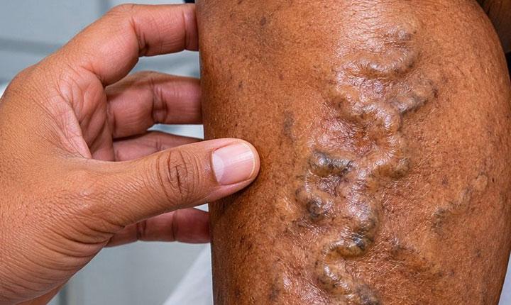 Prefeitura de Eunápolis inicia mutirão inédito para tratamento de varizes que beneficiará mais de 600 pacientes